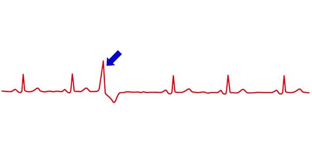 ECG with an extrasystole (blue arrow)
